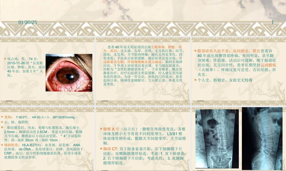 强直性脊柱炎眼部表现病例.ppt