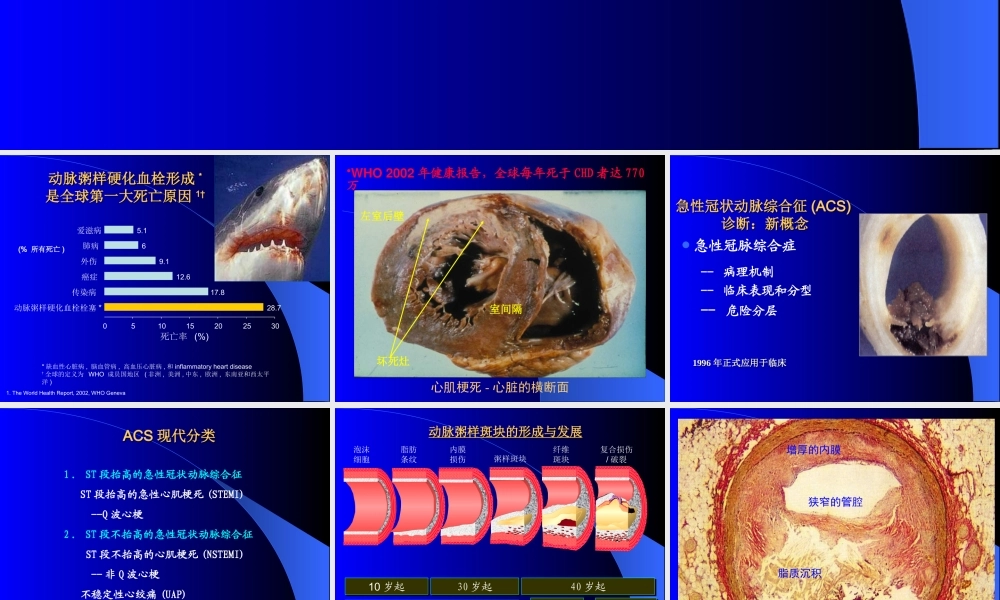 急性冠脉综合征诊治进展.ppt