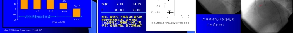 急性冠脉综合征诊治进展.ppt