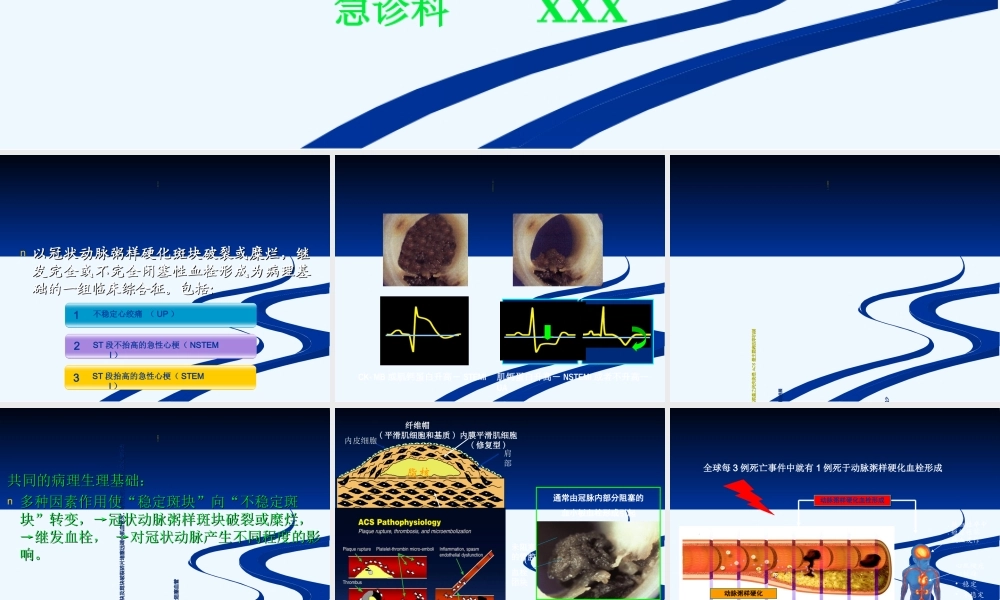 急性冠脉综合症-tr.ppt
