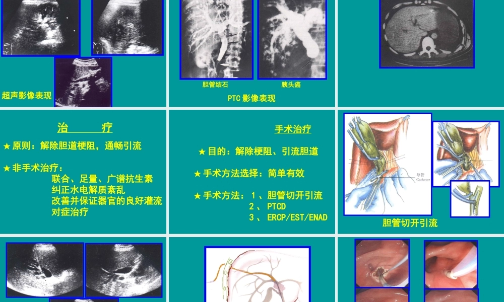 急性化脓性梗阻性胆管炎.ppt