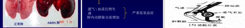 急性呼吸窘迫.ppt