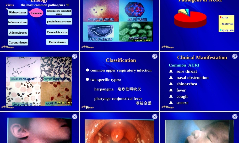 急性呼吸道感染-04级八年制.ppt