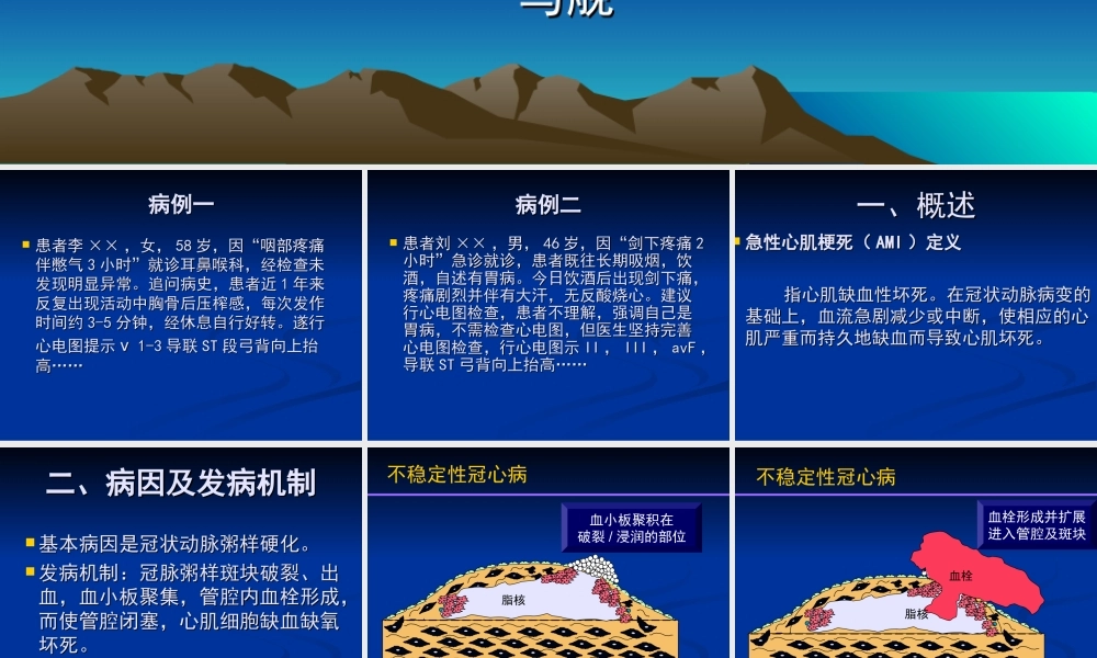 急性心肌梗死-mj.ppt