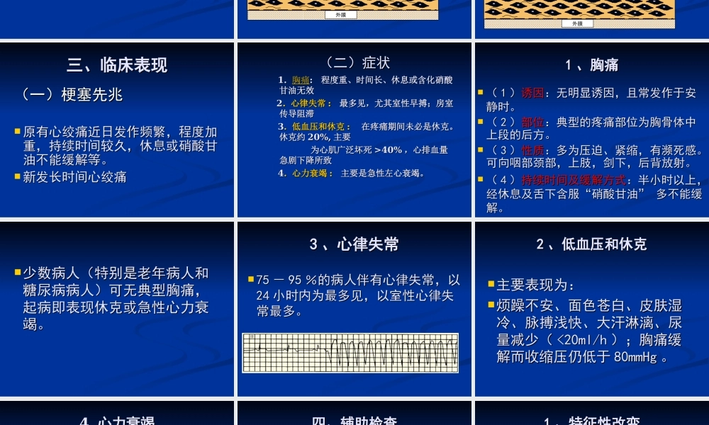 急性心肌梗死-mj.ppt