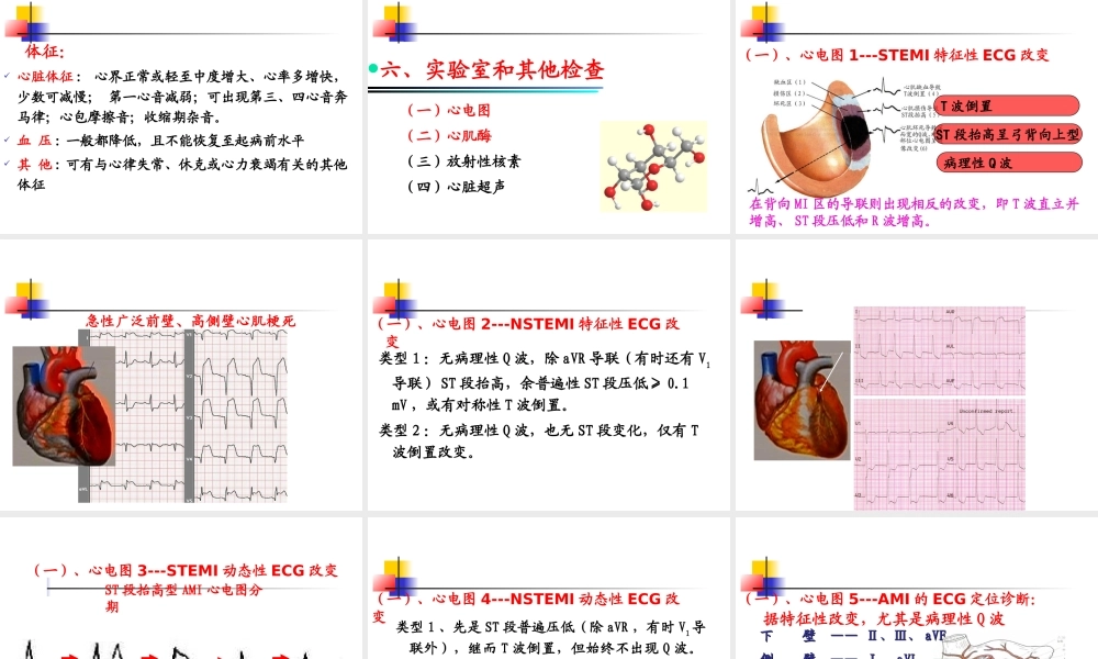 急性心肌梗死-新.ppt
