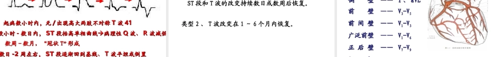 急性心肌梗死-新.ppt