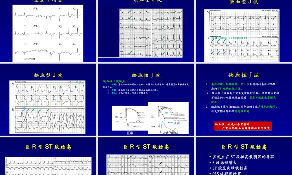 急性心肌梗死猝死的心电图.ppt