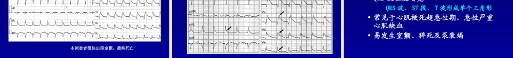 急性心肌梗死猝死的心电图.ppt