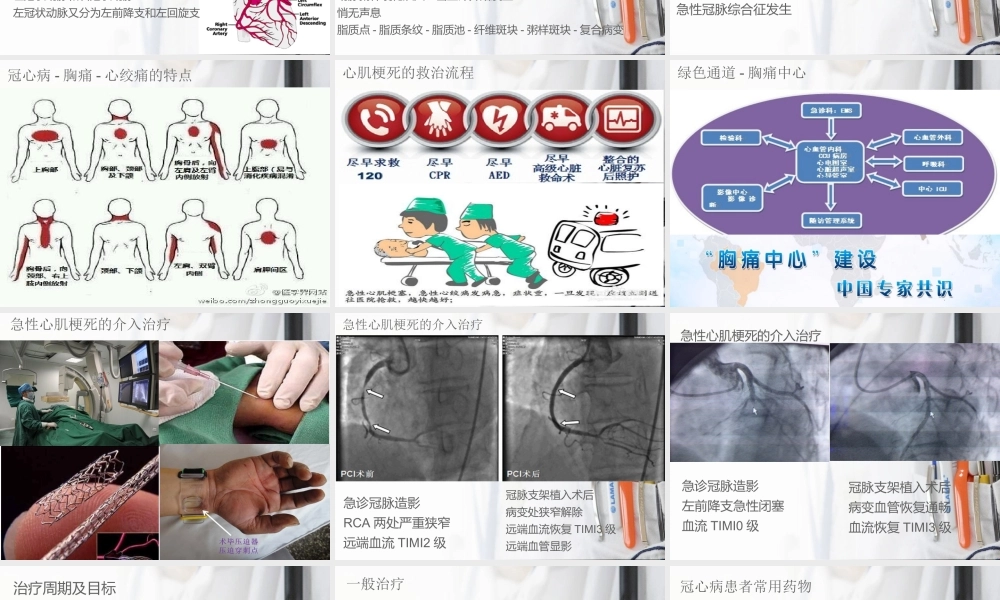 急性心肌梗死科普.ppt