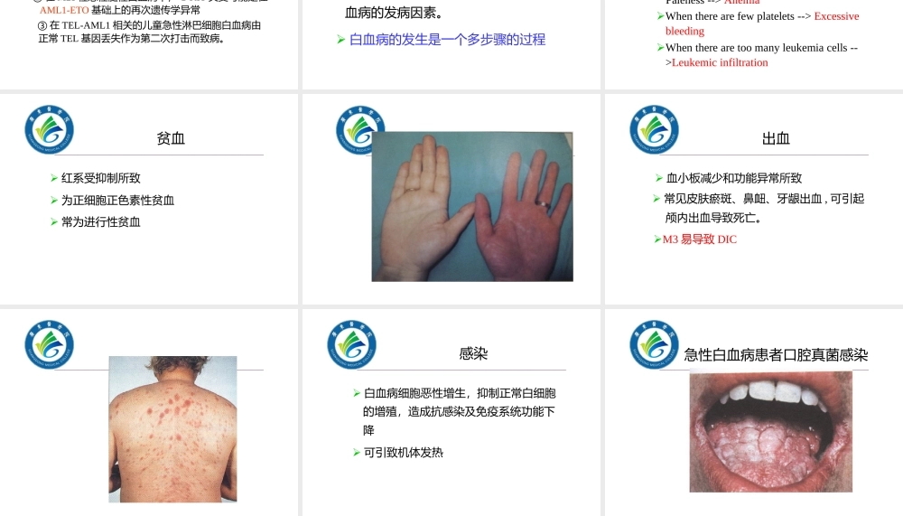 急性白血病概述.pptx