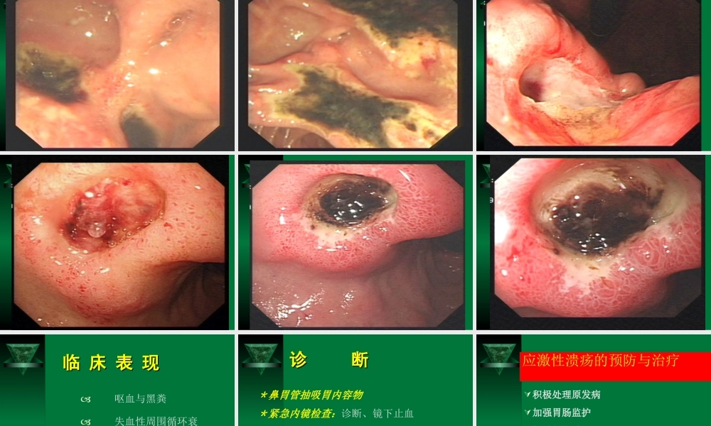 急性胃粘膜病变.ppt