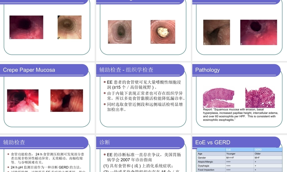 嗜酸细胞性食管炎.ppt