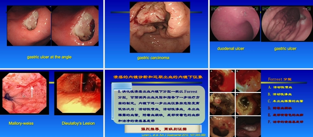 急性非静脉曲张性上消化道出血诊治指南.ppt