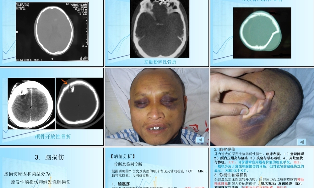 急性颅脑损伤概要.ppt
