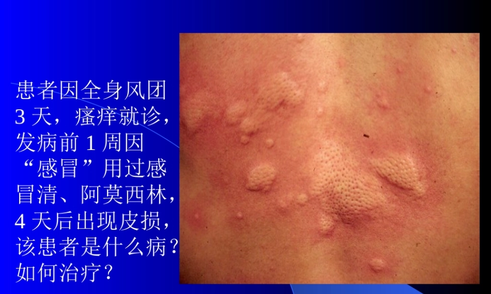 患者因全身风团3天-瘙痒就诊-发病前1周因.ppt