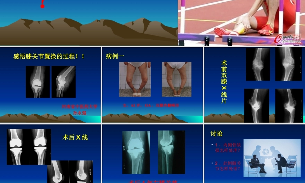感悟膝关节置换的过程!!.ppt