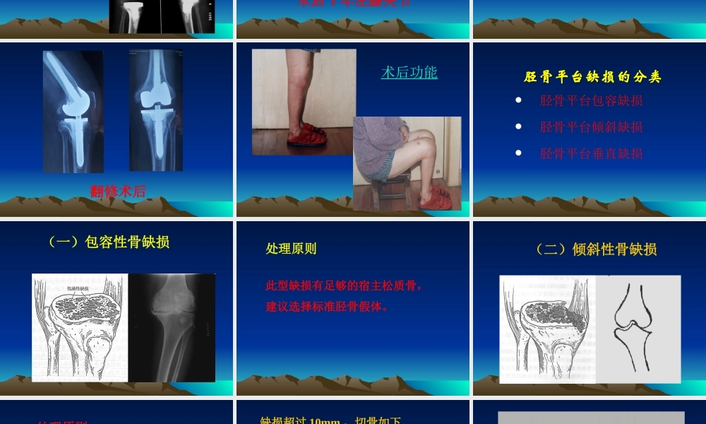 感悟膝关节置换的过程!!.ppt