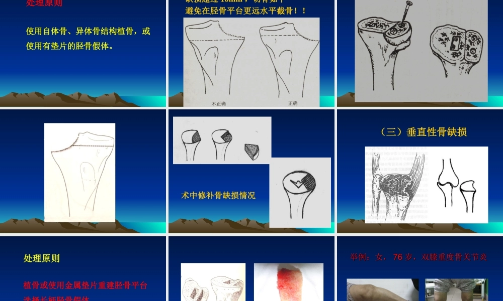 感悟膝关节置换的过程!!.ppt