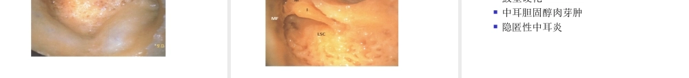 慢性中耳病变诊治策略.ppt