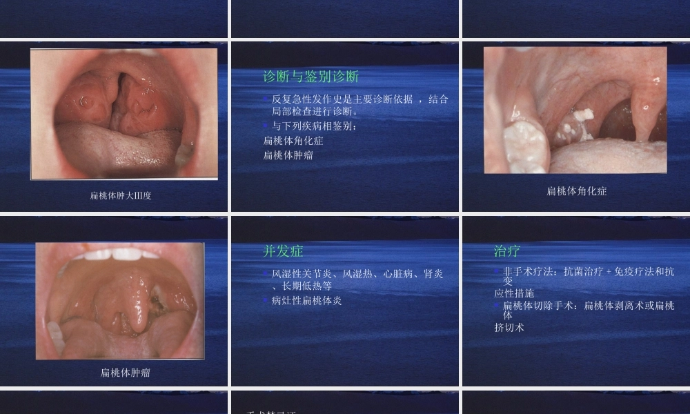 慢性扁桃体炎.ppt