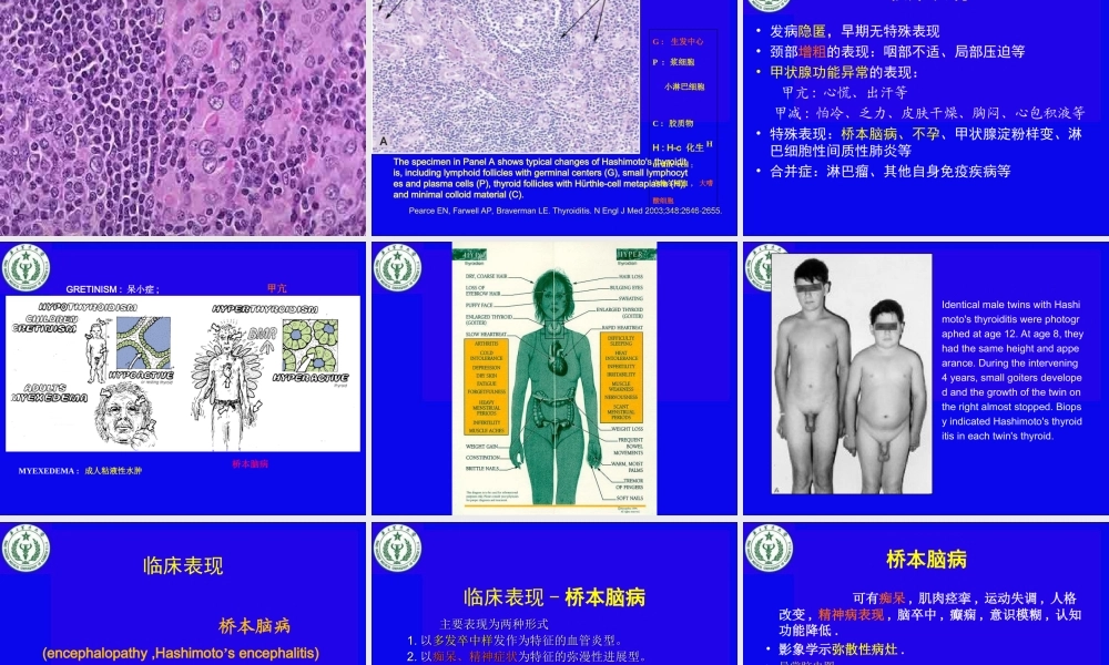 慢性淋巴细胞性甲状腺炎幻灯片.ppt