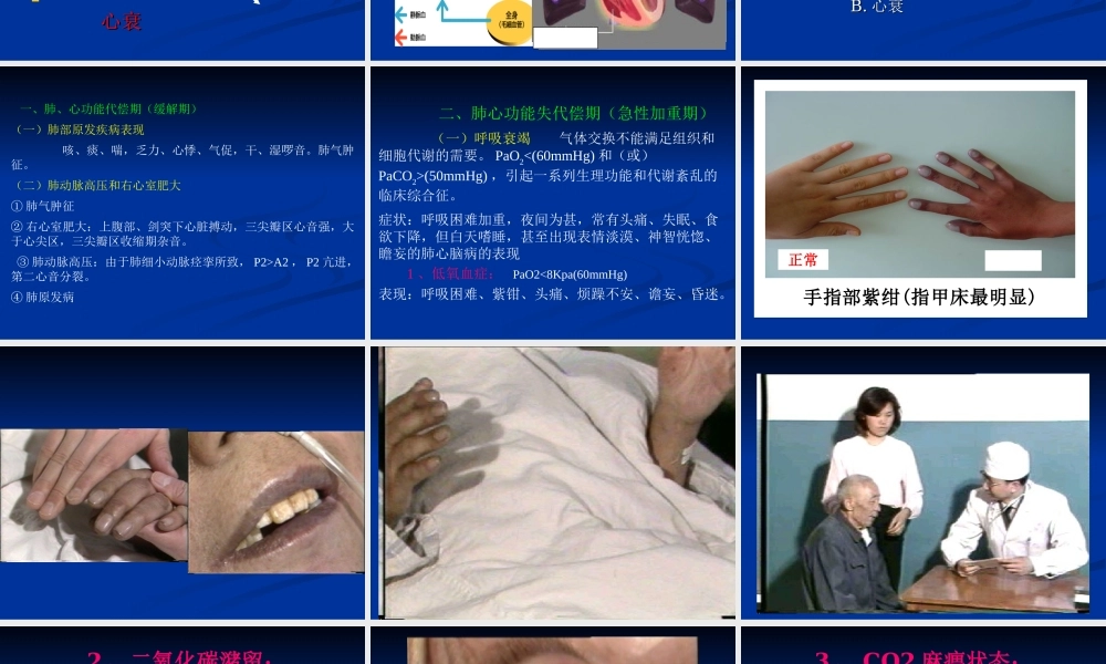 慢性肺源性心脏病sss.ppt