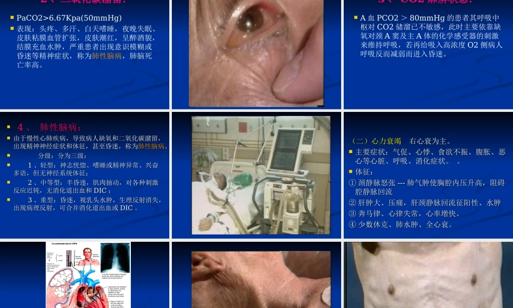 慢性肺源性心脏病sss.ppt