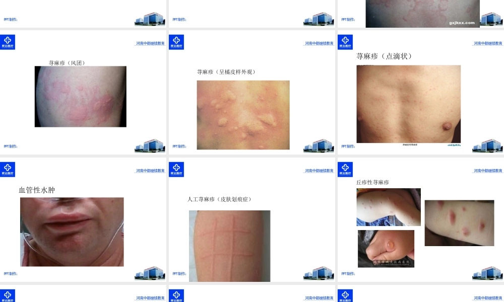 慢性荨麻疹的疹疗.ppt