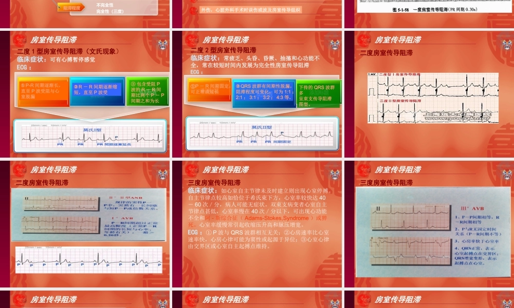 房室传导阻滞-(3).ppt