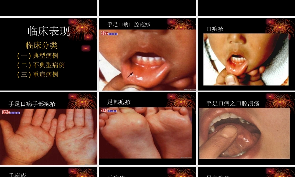 手足口病的诊治及防控.ppt