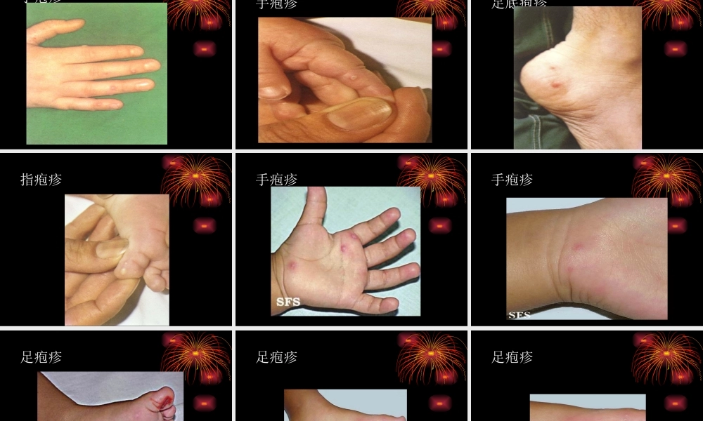 手足口病的诊治及防控.ppt