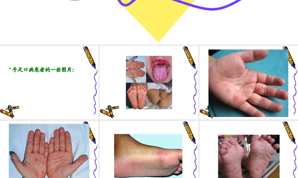 手足口病诊疗指南(王军)10.5.8.ppt