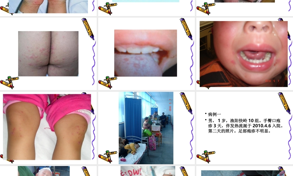 手足口病诊疗指南(王军)10.5.8.ppt