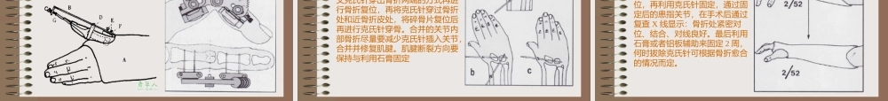 手骨骨折ppt1.ppt