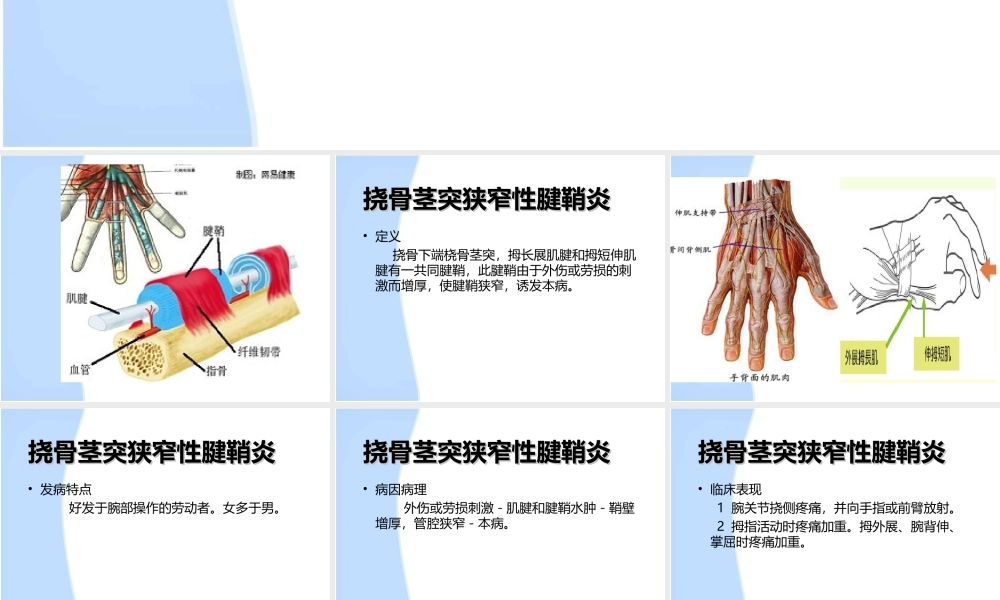 挠骨茎突狭窄性腱鞘炎..ppt