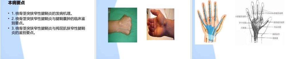 挠骨茎突狭窄性腱鞘炎..ppt