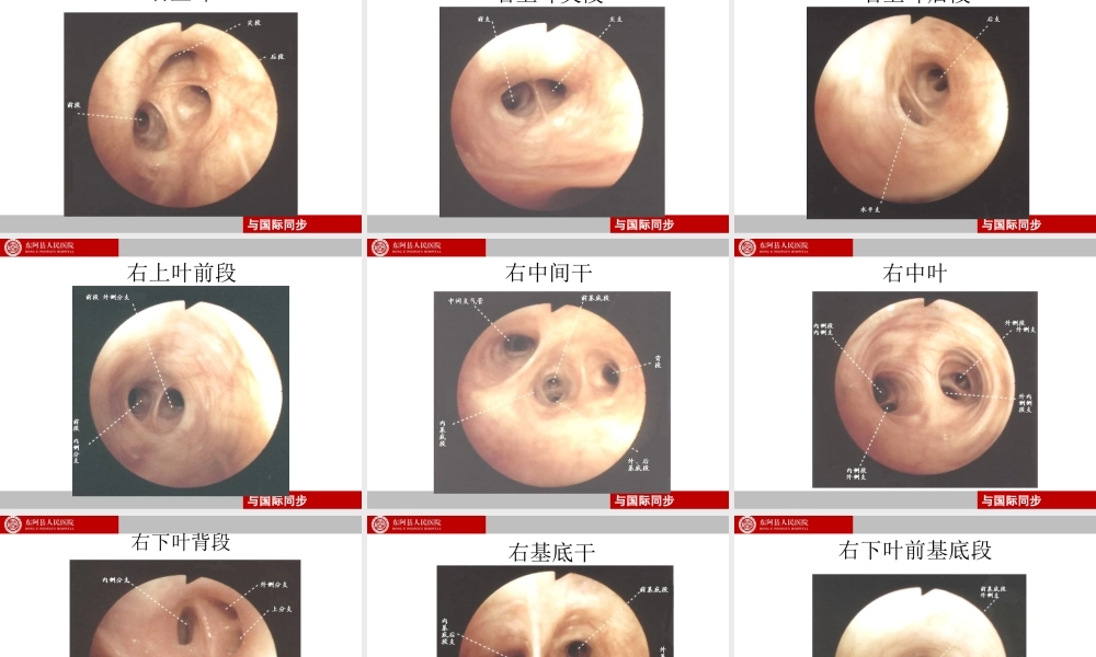 支气管镜下肺脏的分段.ppt