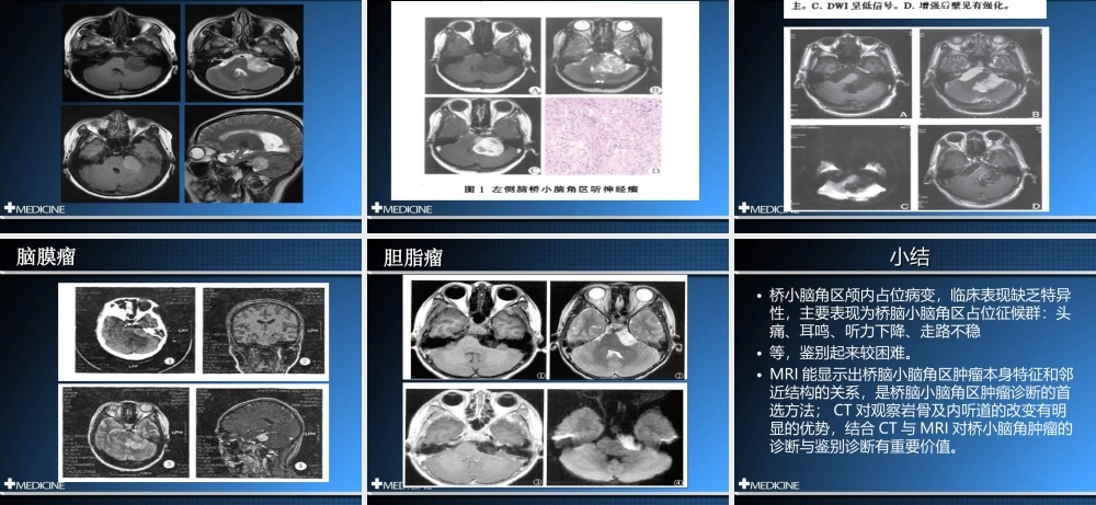 桥小脑角区占位.ppt