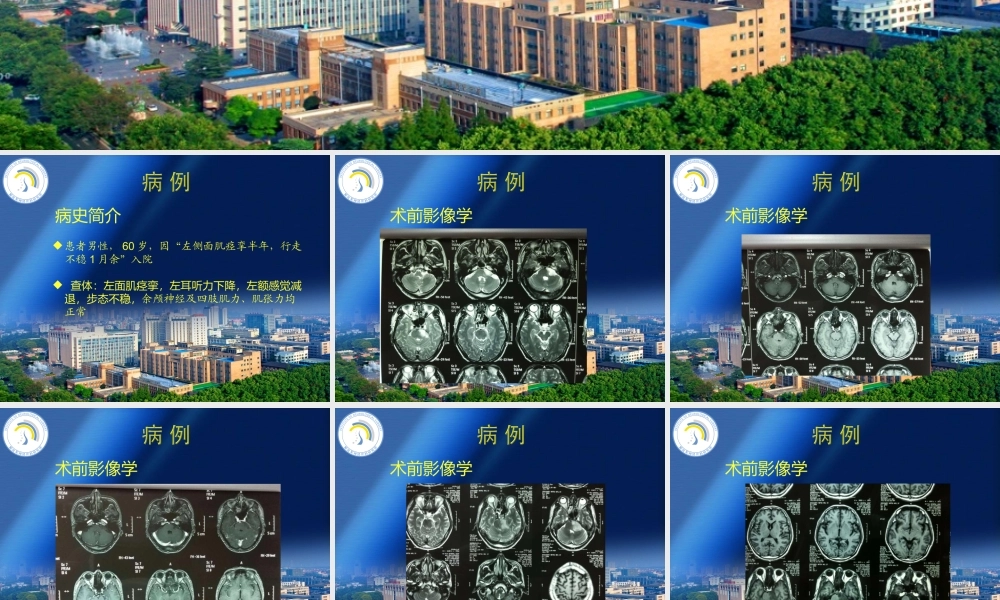 桥小脑角胶质瘤.ppt