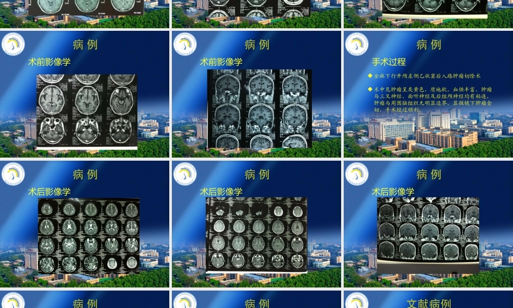 桥小脑角胶质瘤.ppt