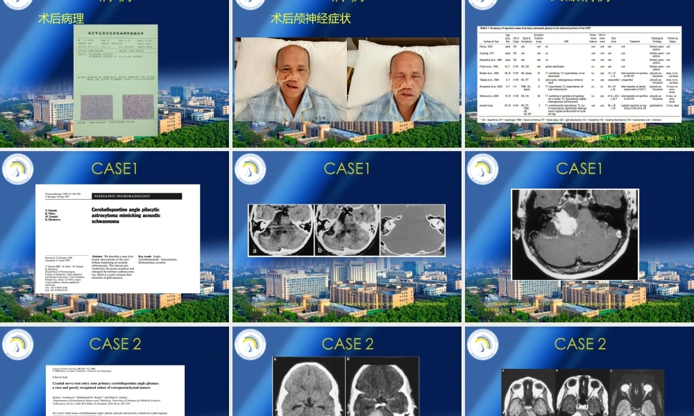 桥小脑角胶质瘤.ppt