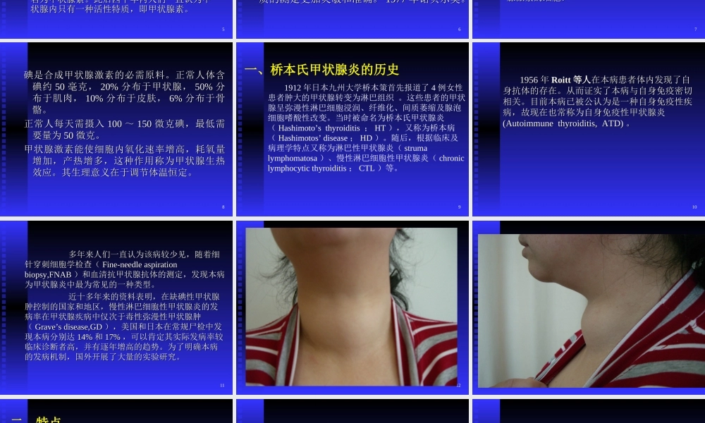桥本病讲稿2.ppt