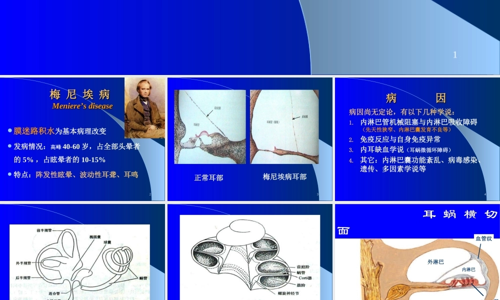 梅尼埃病及耳聋防治(2014)剖析.ppt