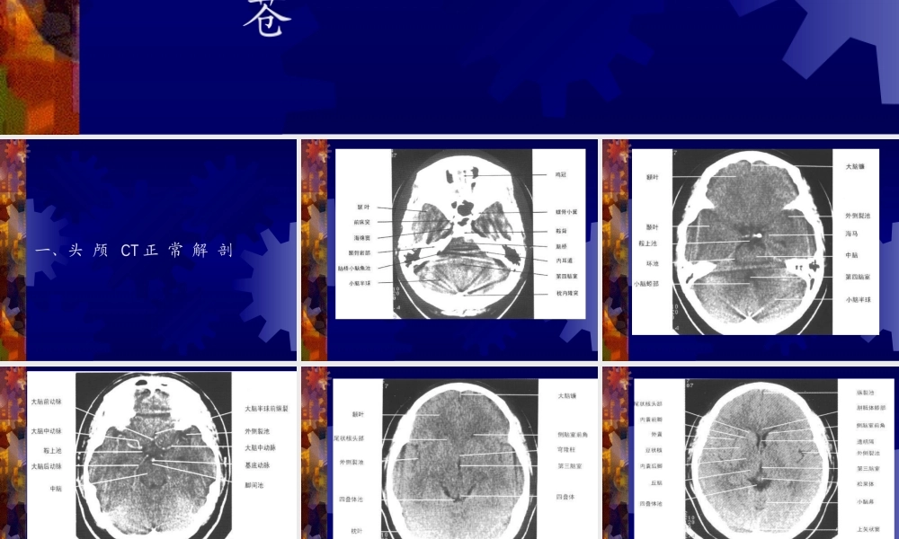 正-常-头-颅-CT-及-MRI-解-剖.ppt
