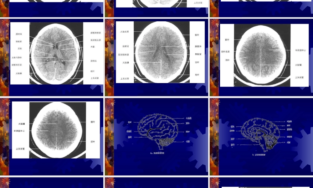 正-常-头-颅-CT-及-MRI-解-剖.ppt