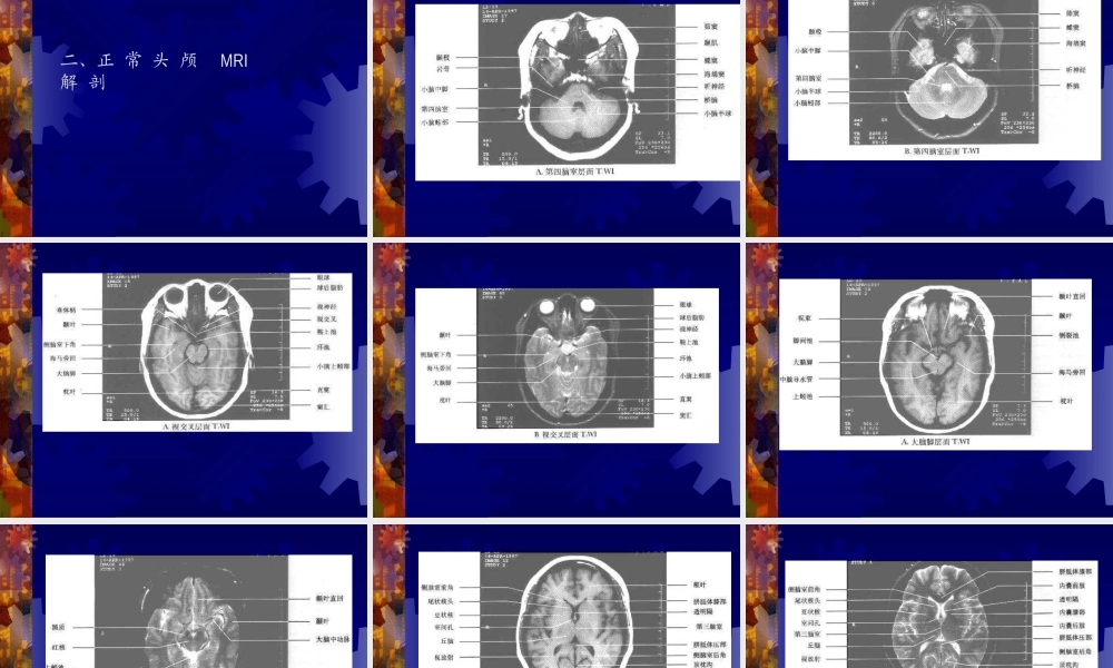 正-常-头-颅-CT-及-MRI-解-剖.ppt