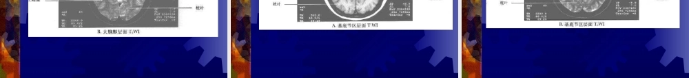 正-常-头-颅-CT-及-MRI-解-剖.ppt