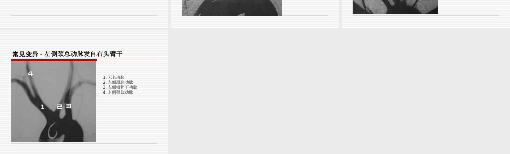 正常主动脉弓和其变异-2003122401.ppt