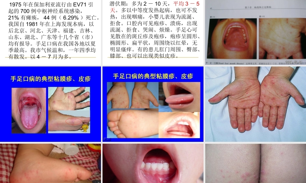 正确认识手足口病.ppt